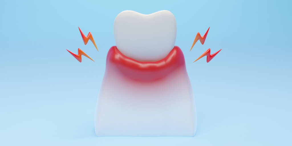 歯周病の原因とは？知らないと危険なポイント