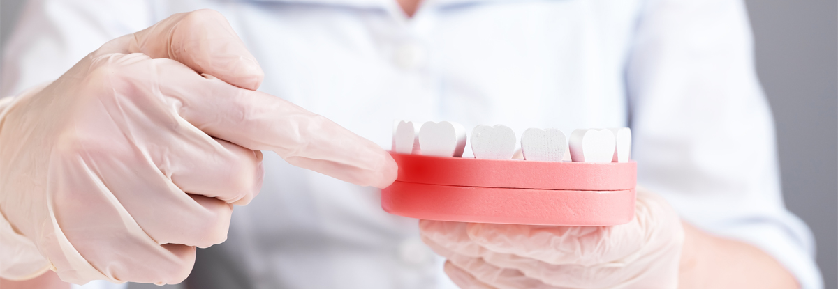 進行した歯周病の症状イメージ