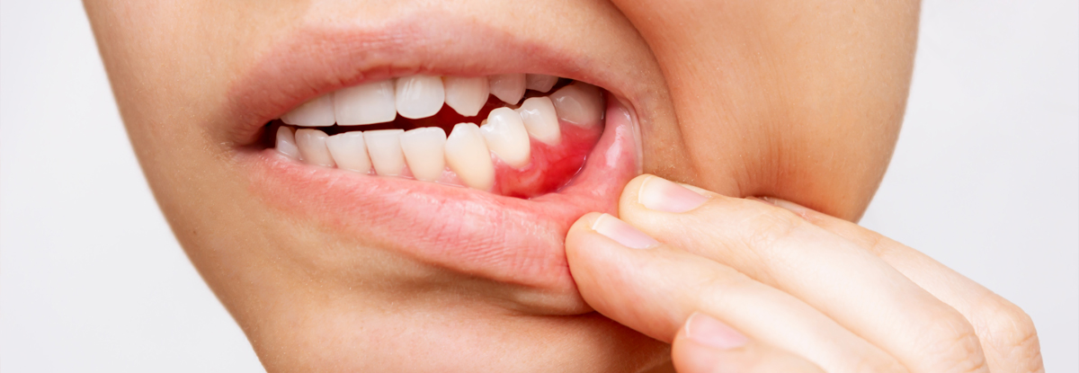 歯周病と全身疾患の関係