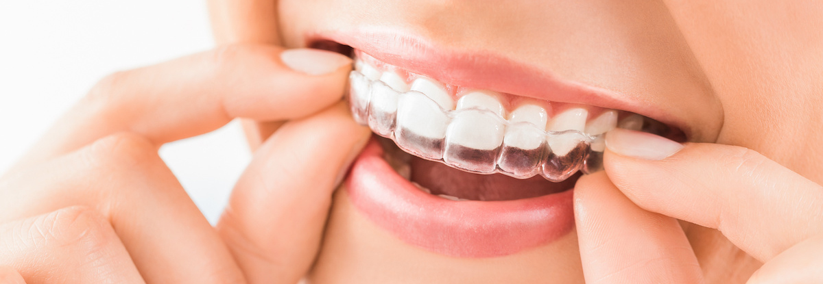 インビザラインのアタッチメント使用時の注意点